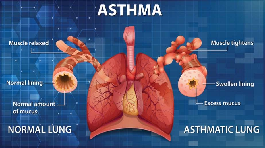 asthma-lung-923w